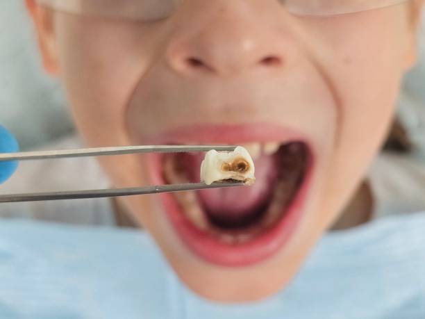 Best Emergency Dentist for Knocked-Out Tooth in Elkader, IA